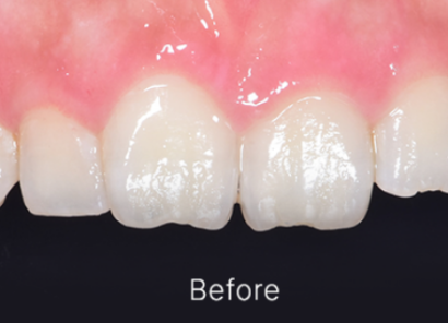 ティースシェイピング BEFORE
