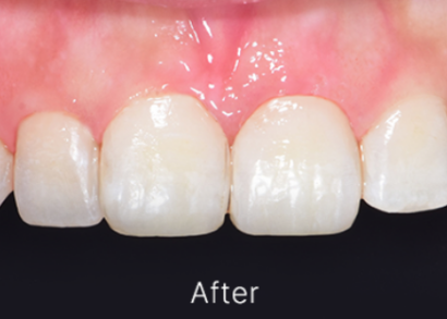 ティースシェイピング AFTER
