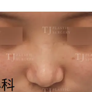 鼻整形 AFTER