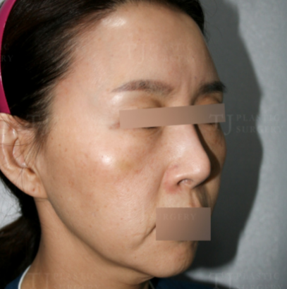 脂肪注入＆切開ハムラ＆糸リフト BEFORE