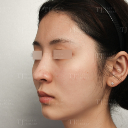 エラ削り＆脂肪移植 BEFORE