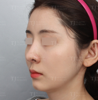 エラ削り＆脂肪移植 AFTER