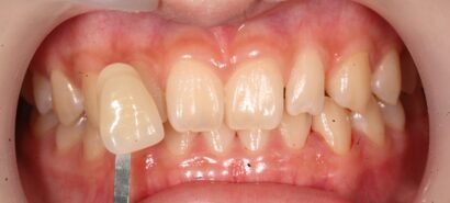 ホワイトニング BEFORE