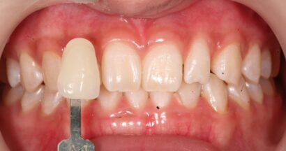 ホワイトニング AFTER