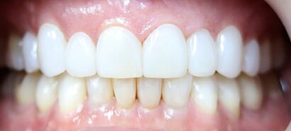 ラミネート AFTER