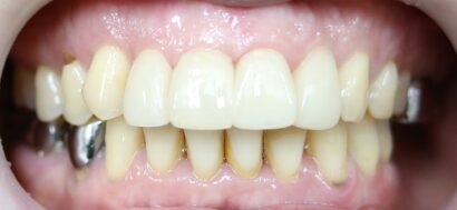 ラミネート+クラウン AFTER