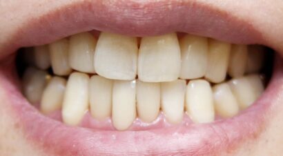 ラミネート+クラウン AFTER