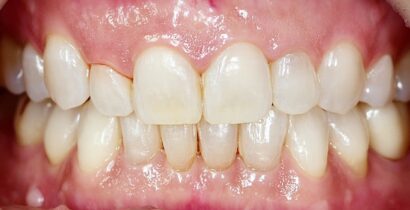 ラミネート BEFORE