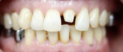 ラミネート+クラウン BEFORE