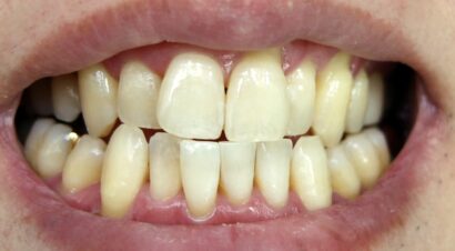 ラミネート+クラウン BEFORE