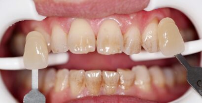 ホワイトニング BEFORE