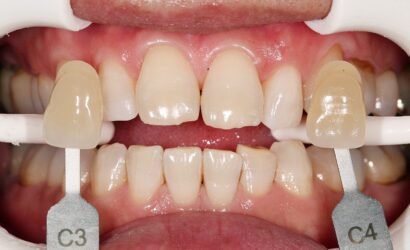 ホワイトニング AFTER