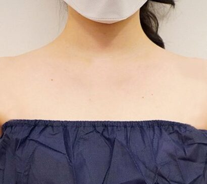 Trapezius CAT / 僧帽キャット AFTER