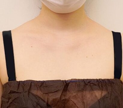 Trapezius CAT / 僧帽キャット BEFORE