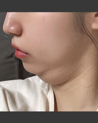 フェイスライン BEFORE