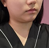 フェイスライン BEFORE