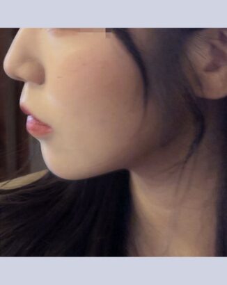 フェイスライン AFTER