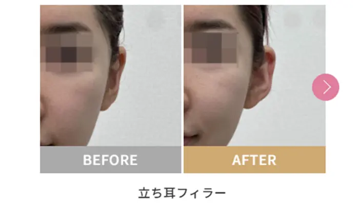 立ち耳フィラー