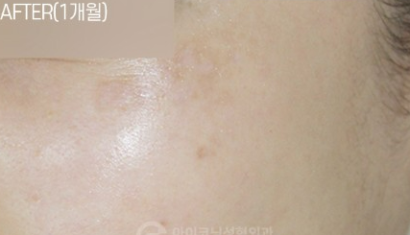 デュアルトーニング AFTER