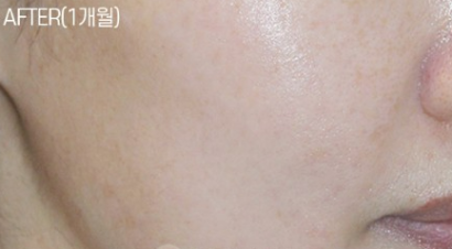 デュアルトーニング AFTER