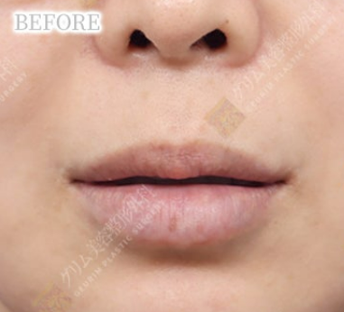 鼻下切開内側人中短縮＋Cカール BEFORE