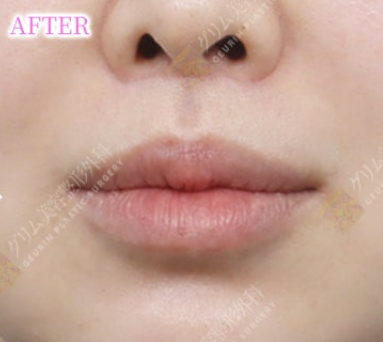 鼻下切開内側人中短縮＋Cカール AFTER