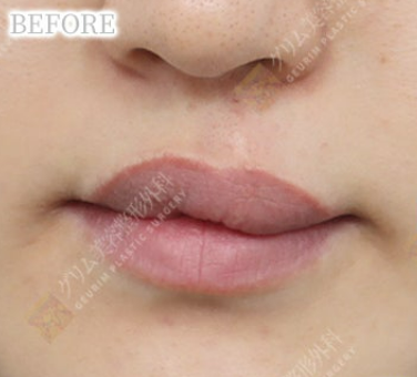 口唇口蓋裂(上唇/人中傷跡修正＋上唇ライン矯正＋口角挙上) BEFORE