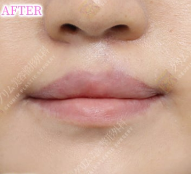 口唇口蓋裂(上唇/人中傷跡修正＋上唇ライン矯正＋口角挙上) AFTER