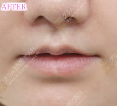 鼻下切開内側人中短縮＋Cカール(他院修正) AFTER