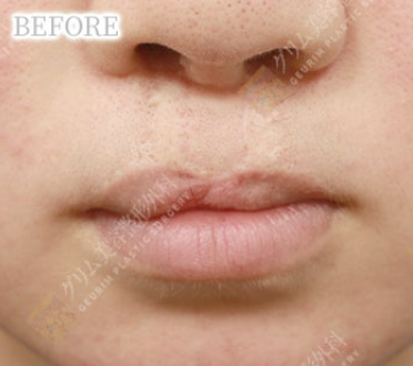 口唇口蓋裂(上唇ライン/粘膜ライン矯正＋人中/上唇傷跡修正＋口角挙上) BEFORE