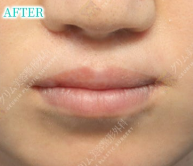 口唇口蓋裂(上唇ライン/粘膜ライン矯正＋人中/上唇傷跡修正＋口角挙上) AFTER
