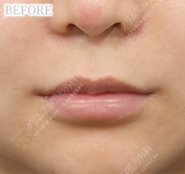 鼻下切開内側人中短縮＋Cカール BEFORE