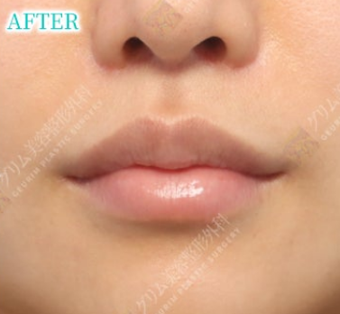 鼻下切開内側人中短縮＋Cカール AFTER