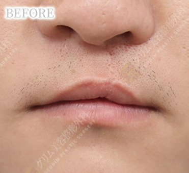 口唇口蓋裂(人中/上唇傷跡修正＋上唇ライン矯正＋口角挙上) BEFORE
