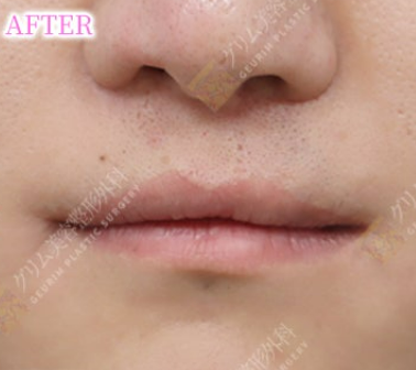 口唇口蓋裂(人中/上唇傷跡修正＋上唇ライン矯正＋口角挙上) AFTER