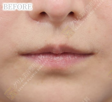 上唇拡大再建術＋口角挙上再建術＋下唇縮小＋Cカール(他院修正) BEFORE