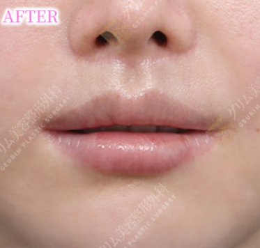 上唇拡大再建術＋口角挙上再建術＋下唇縮小＋Cカール(他院修正) AFTER