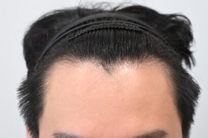 男性非切開（ヒドゥンカット）2,000株 BEFORE