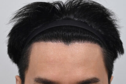 男性非切開（ヒドゥンカット）2,000株 AFTER