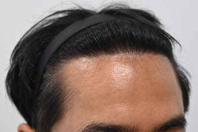 男性非切開（ヒドゥンカット）3,000株 AFTER