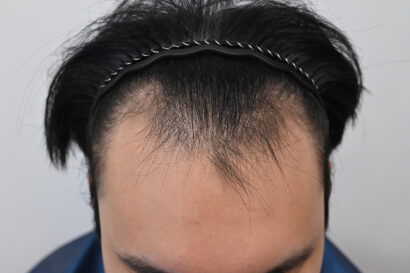 男性非切開（ヒドゥンカット）4,500株 BEFORE