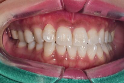 ホワイトニング3回照射 AFTER