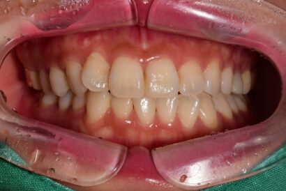 ホワイトニング3回照射 BEFORE