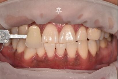 ホワイトニング AFTER