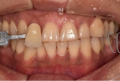 ホワイトニング BEFORE