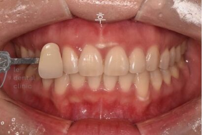 ホワイトニング AFTER