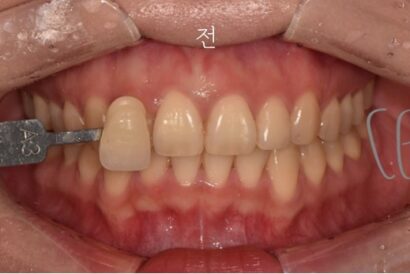 ホワイトニング BEFORE