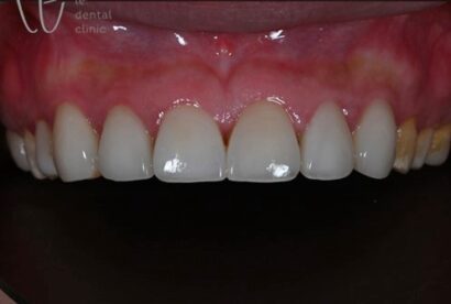 ラミネート BEFORE