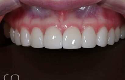 ラミネート AFTER