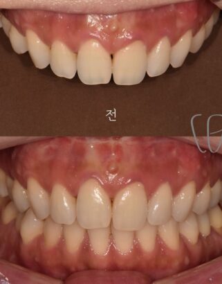 ラミネート BEFORE